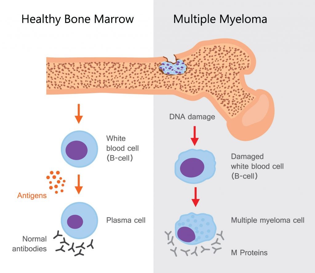 A case of Multiple Myeloma with bone resorption